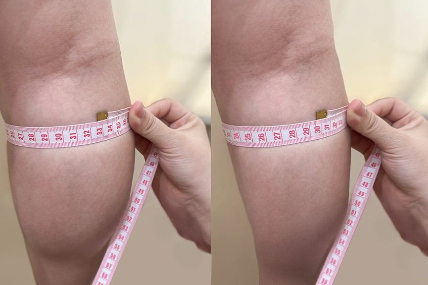 Tiêm botox thu gọn bắp chân
