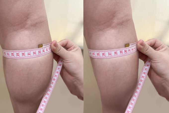 Tiêm botox thu gọn bắp chân